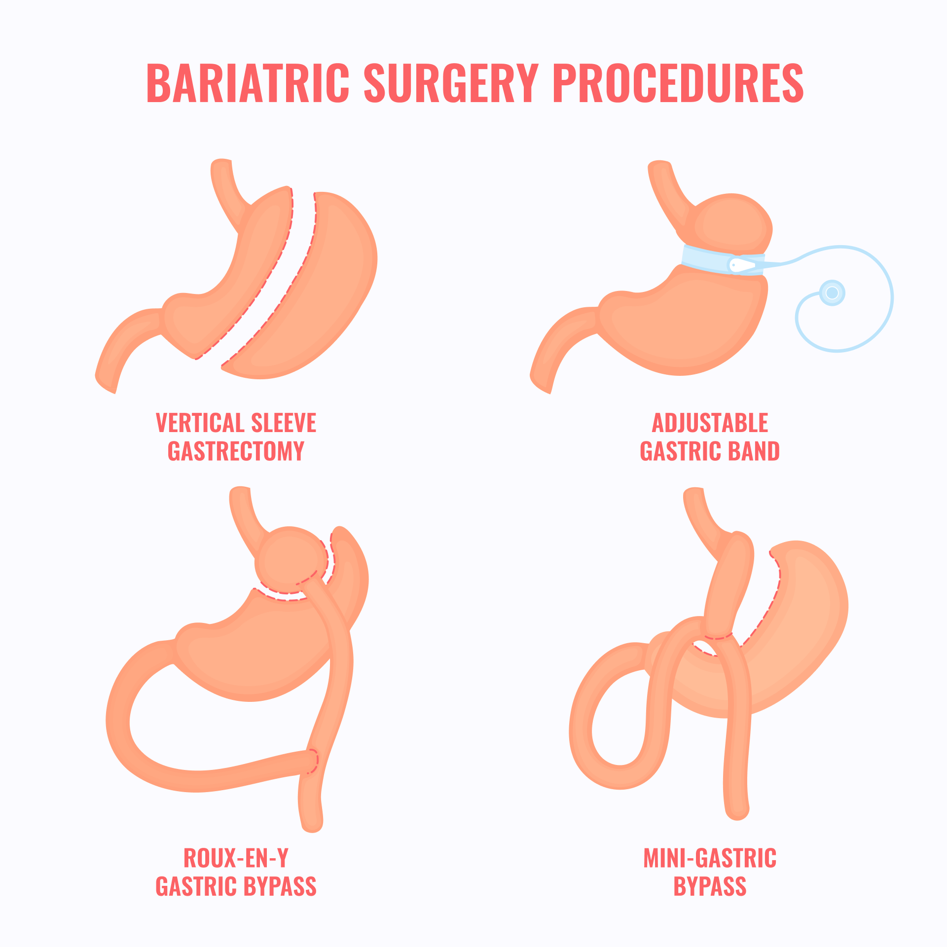 Gastric Bypass Surgery - Macquarie Weight Loss and Surgical Services